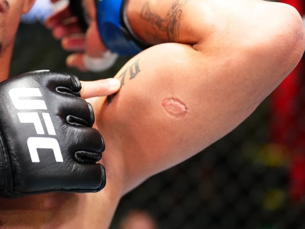 UFC mordida é permitido? Entenda as regras do esporte.