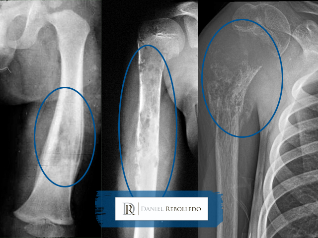 Sarcoma de Ewing (Ewing Pat): Sintomas, diagnóstico e próximos passos