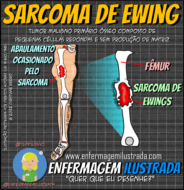 Sarcoma de Ewing (Ewing Pat): Sintomas, diagnóstico e próximos passos